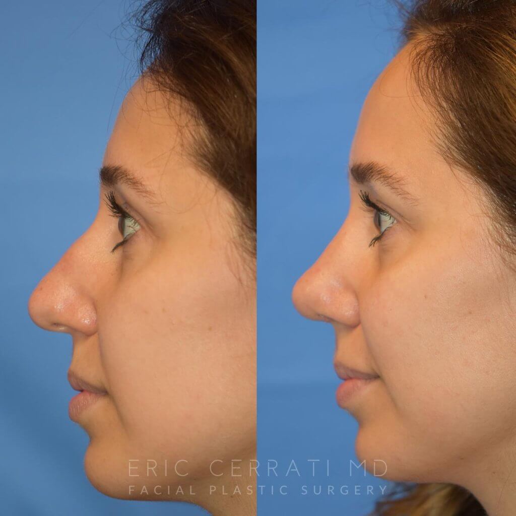 Female patient before and after rhinoplasty - left side