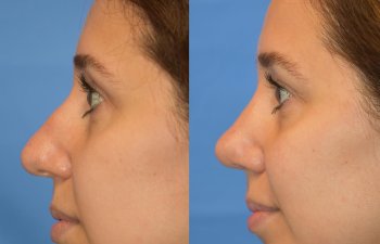 Female patient before and after rhinoplasty - left side