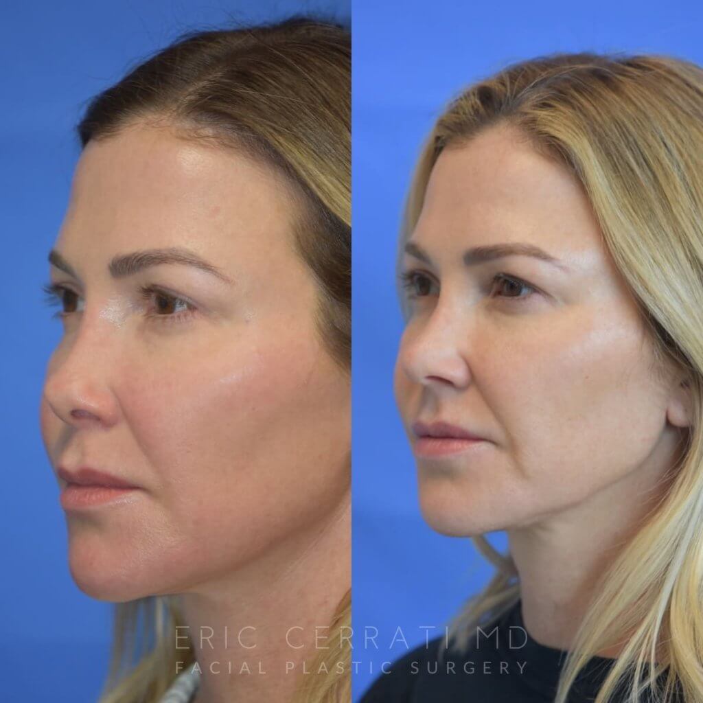 Female patient before and after rhinoplasty - left side