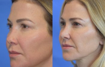 Female patient before and after rhinoplasty - left side