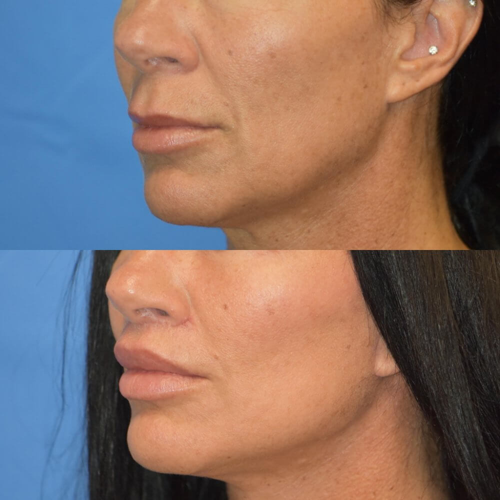 Salt Lake City UT Lip Augmentation Before and After Pictures Park City