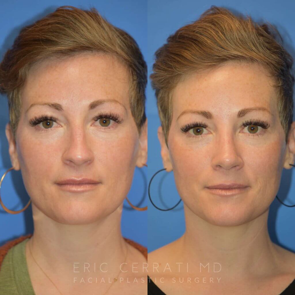 Female patient before and after rhinoplasty - front