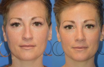 Female patient before and after rhinoplasty - front