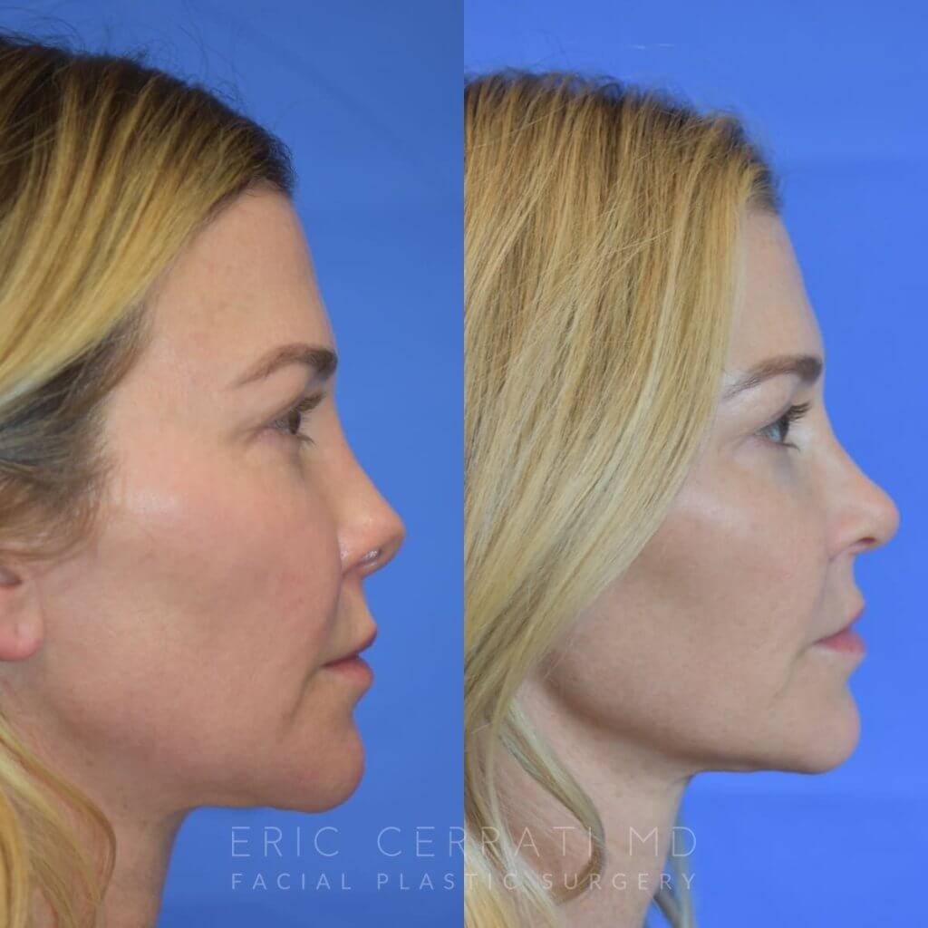 Female patient before and after rhinoplasty - right side