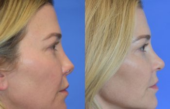 Female patient before and after rhinoplasty - right side