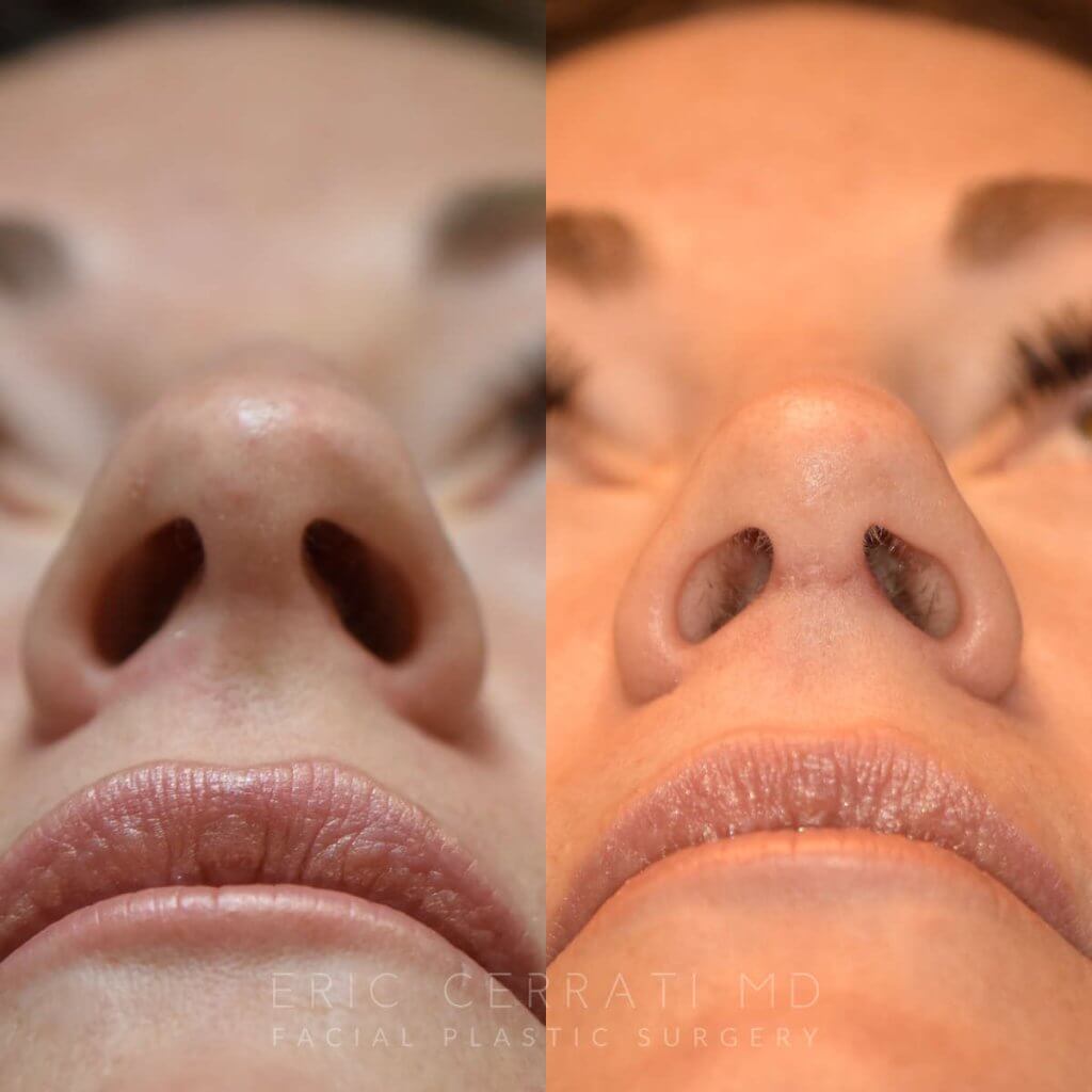 Female patient before and after rhinoplasty - front
