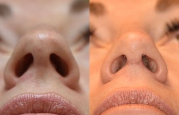 Female patient before and after rhinoplasty - front