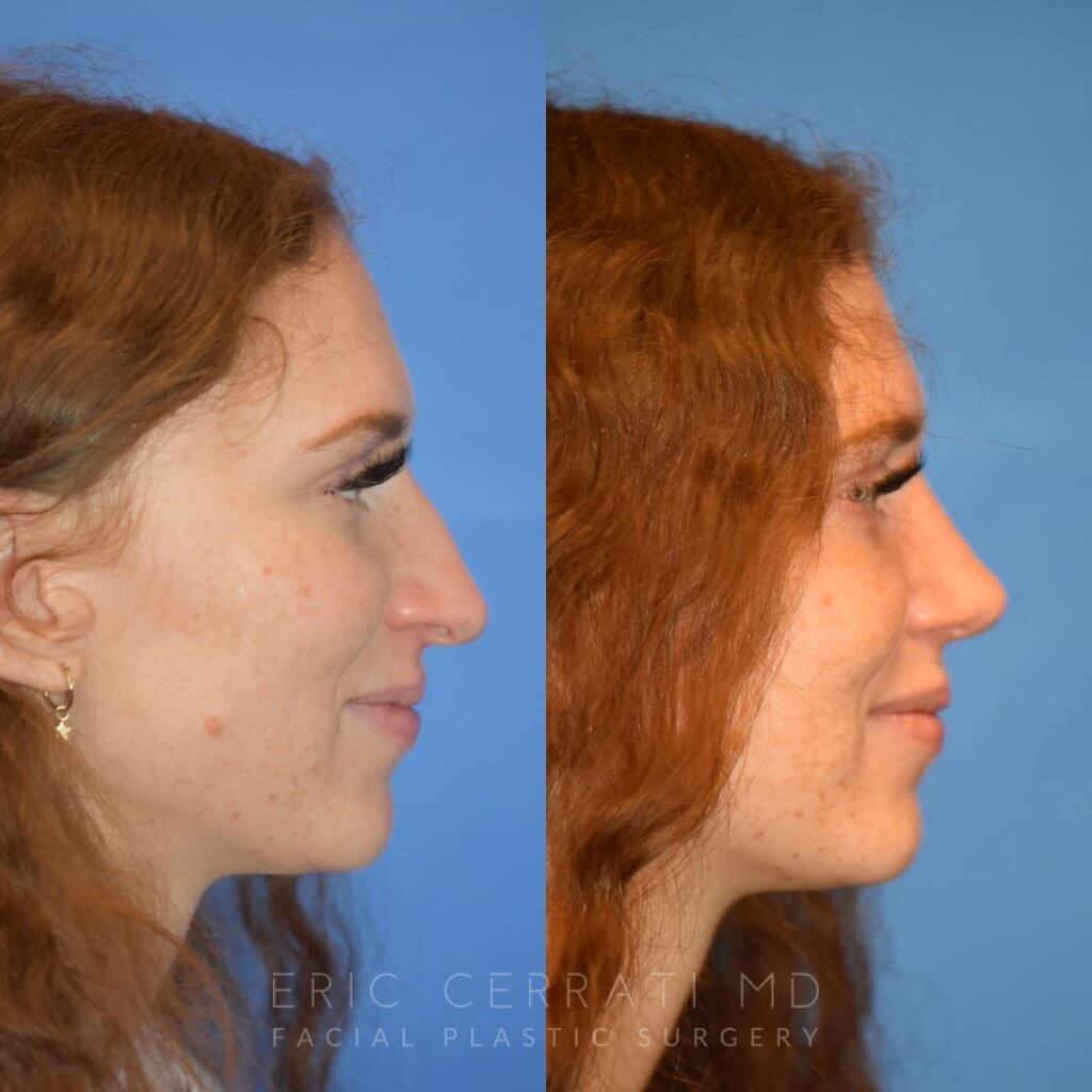 Female patient before and after rhinoplasty - right side