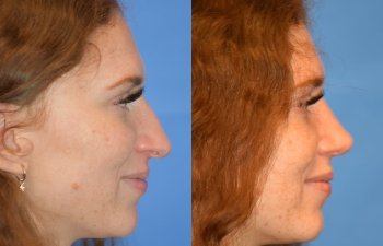 Female patient before and after rhinoplasty - right side
