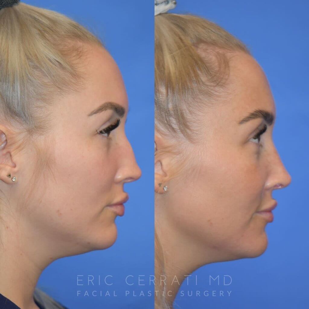 Female patient before and after rhinoplasty - right side