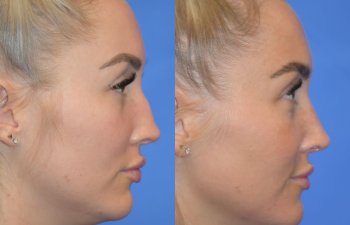 Female patient before and after rhinoplasty - right side