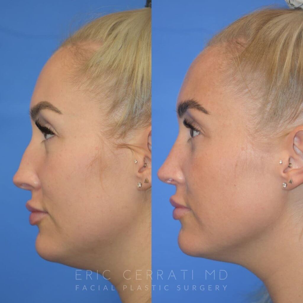 Female patient before and after rhinoplasty - left side