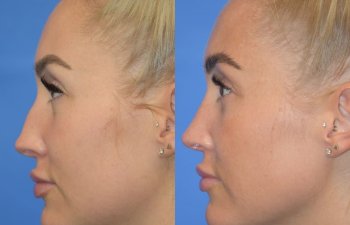 Female patient before and after rhinoplasty - left side