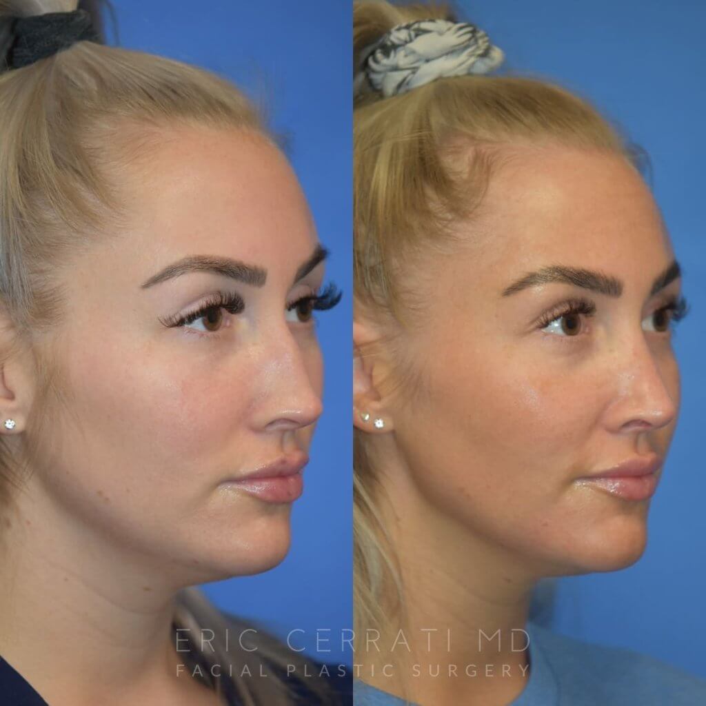 Female patient before and after rhinoplasty - right side