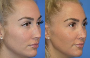 Female patient before and after rhinoplasty - right side