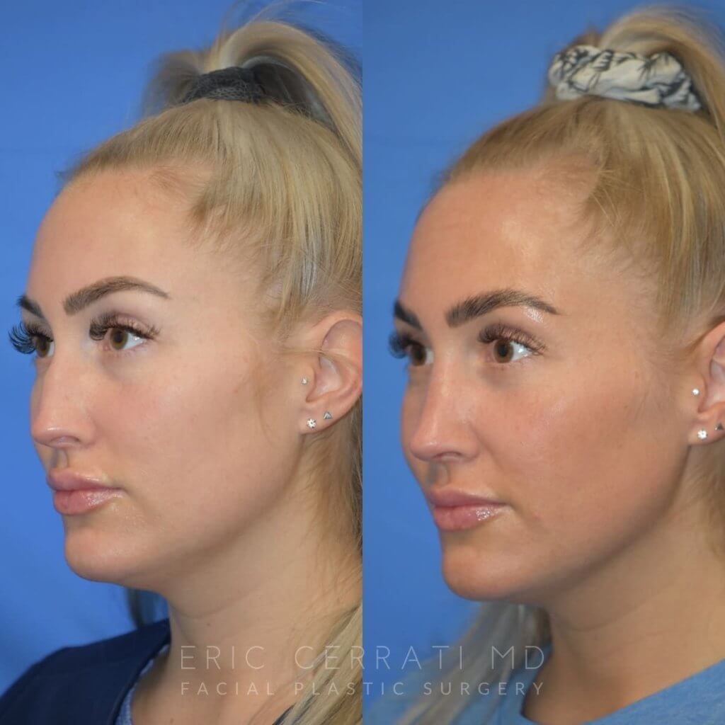 Female patient before and after rhinoplasty - left side