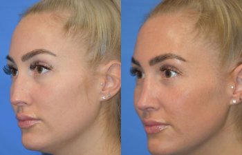 Female patient before and after rhinoplasty - left side