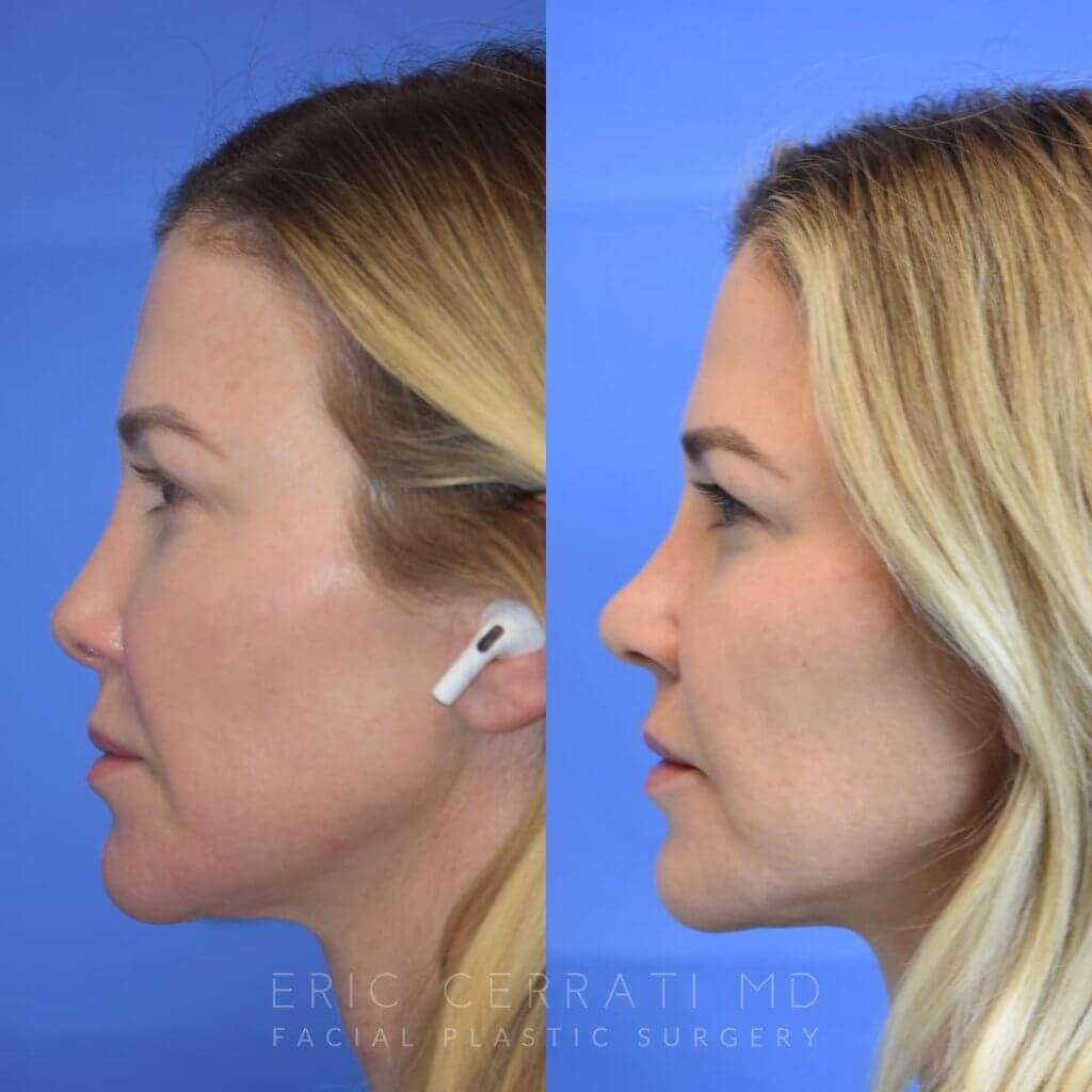Female patient before and after rhinoplasty - left side