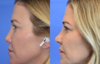 Female patient before and after rhinoplasty - left side