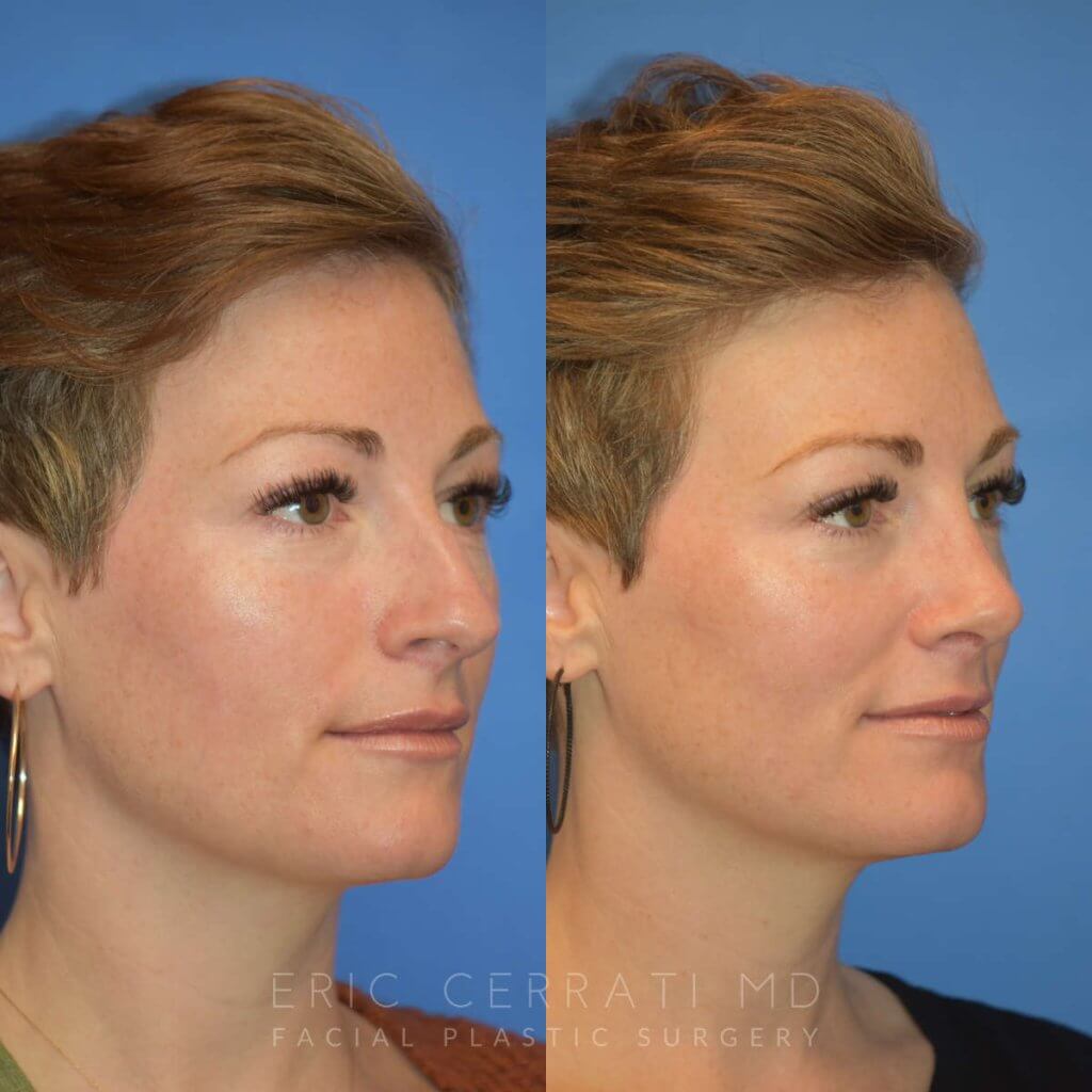 Female patient before and after rhinoplasty - right side