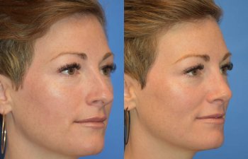 Female patient before and after rhinoplasty - right side