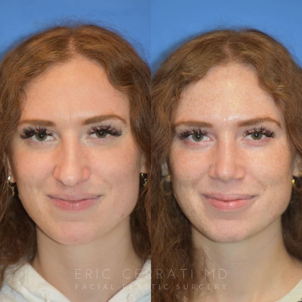 Female patient before and after rhinoplasty - front
