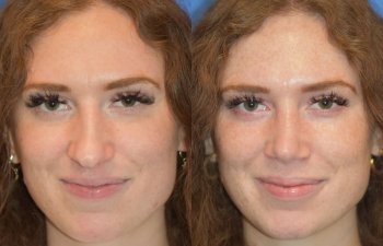 Female patient before and after rhinoplasty - front