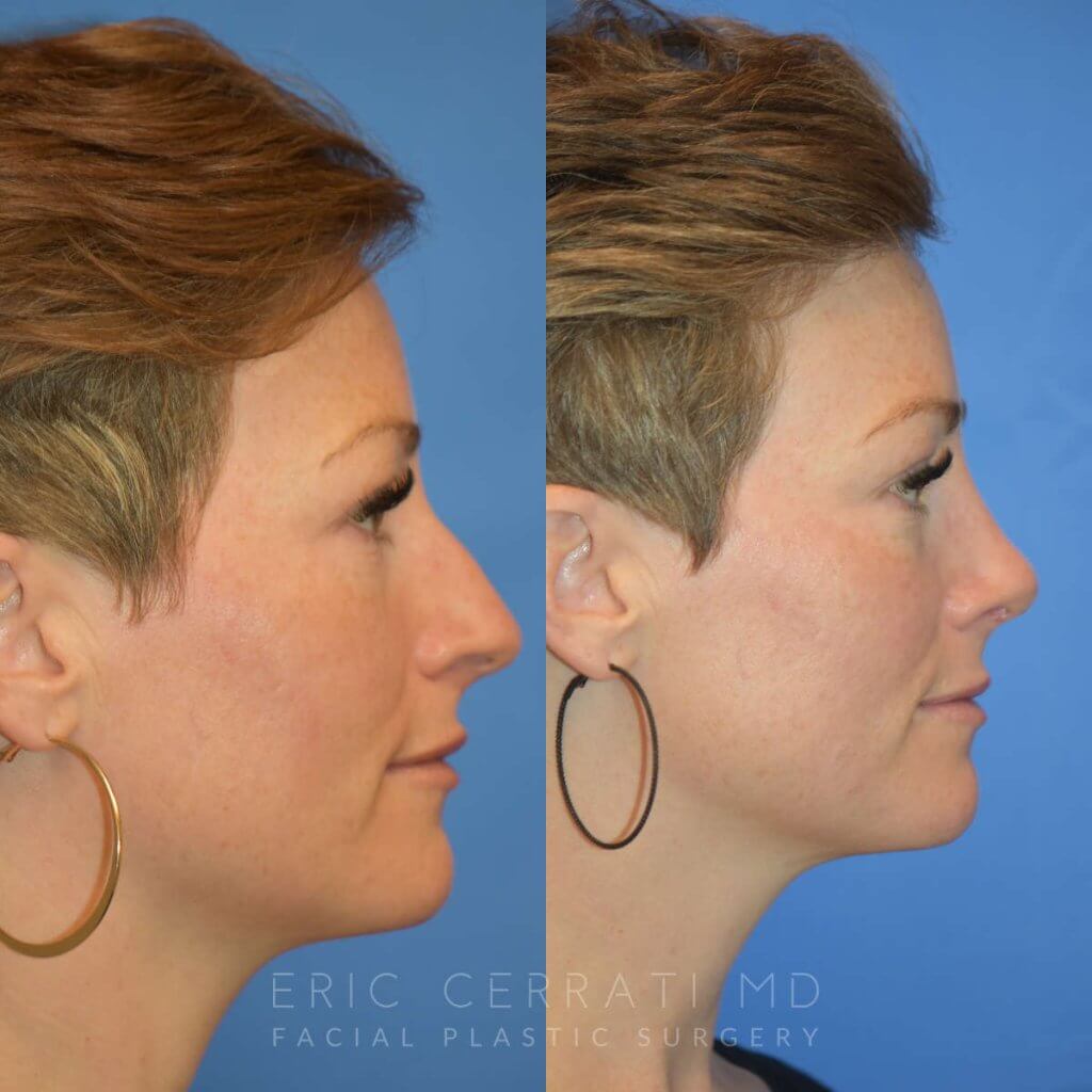 Female patient before and after rhinoplasty - right side