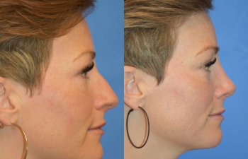 Female patient before and after rhinoplasty - right side