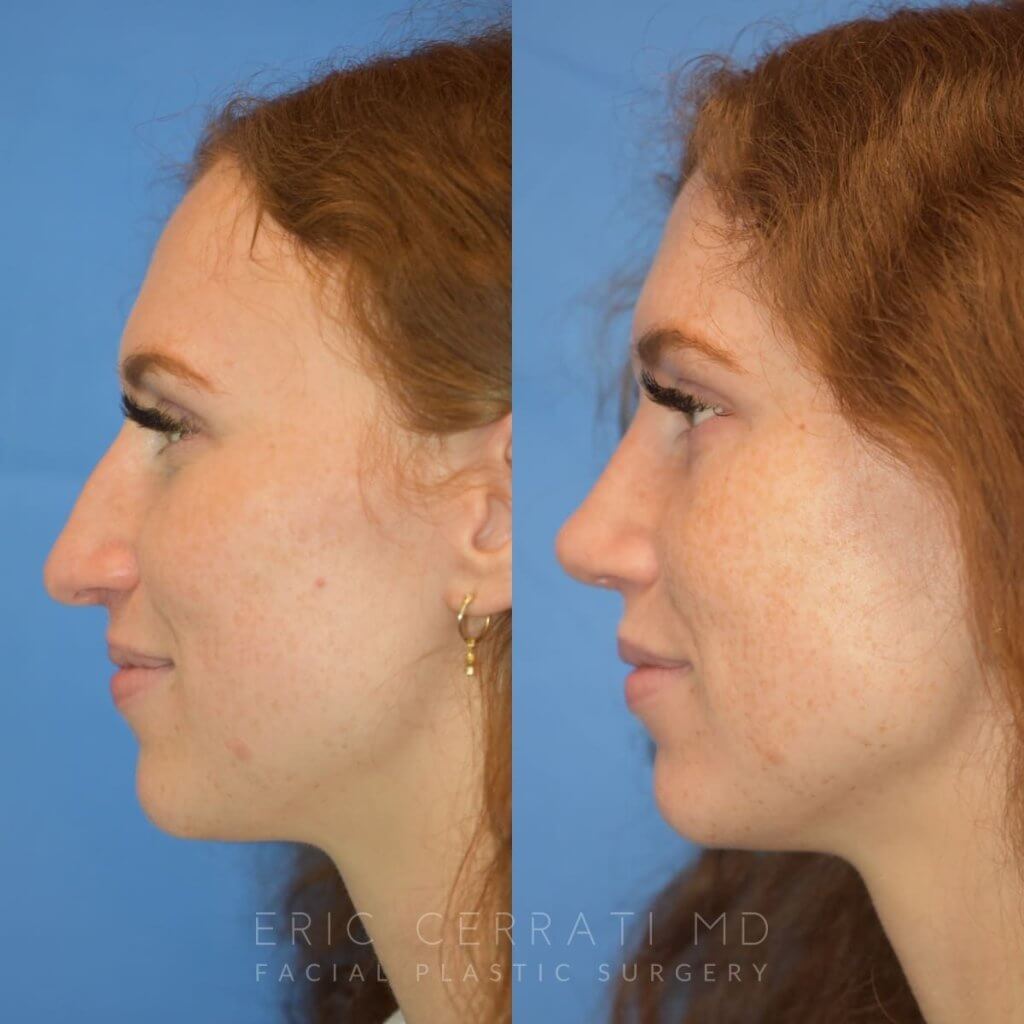 Female patient before and after rhinoplasty - left side