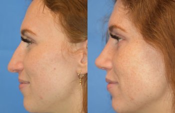 Female patient before and after rhinoplasty - left side