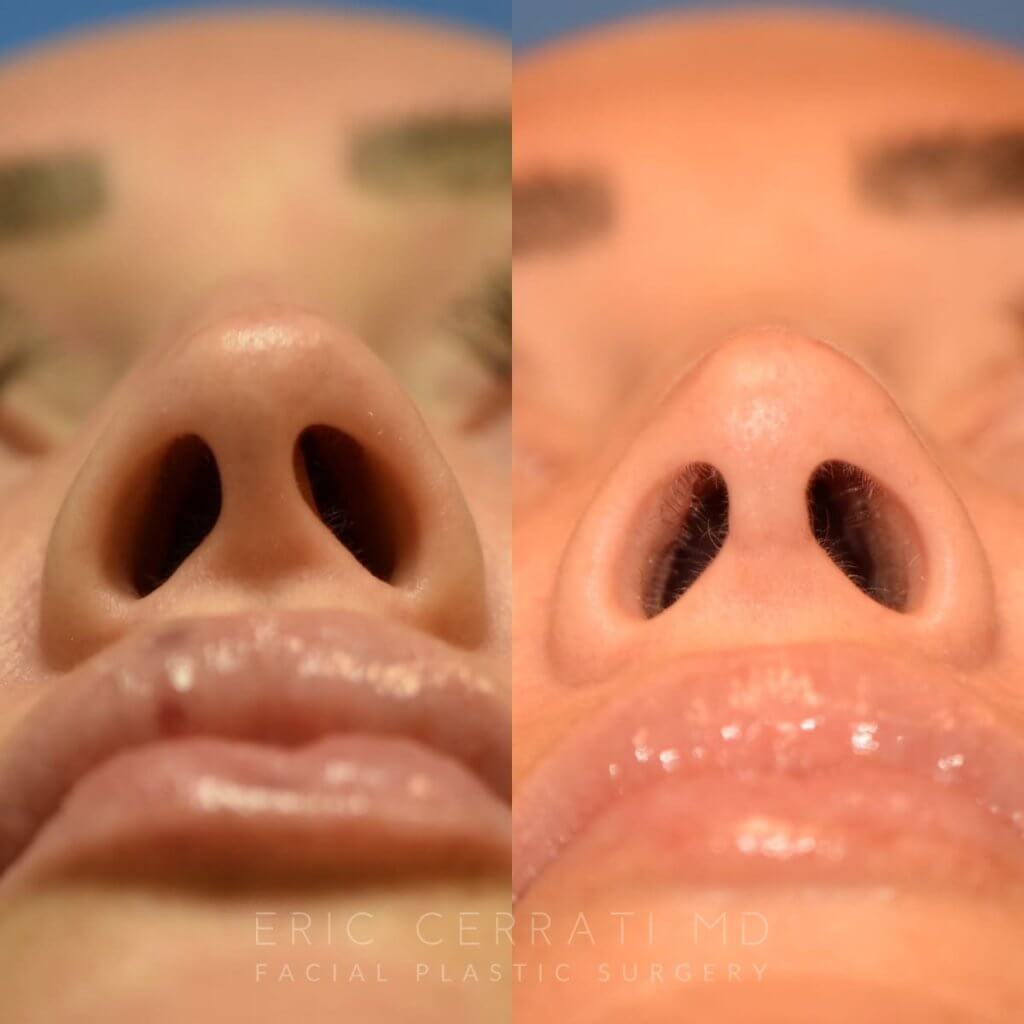 Female patient before and after rhinoplasty - left side