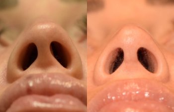 Female patient before and after rhinoplasty - left side