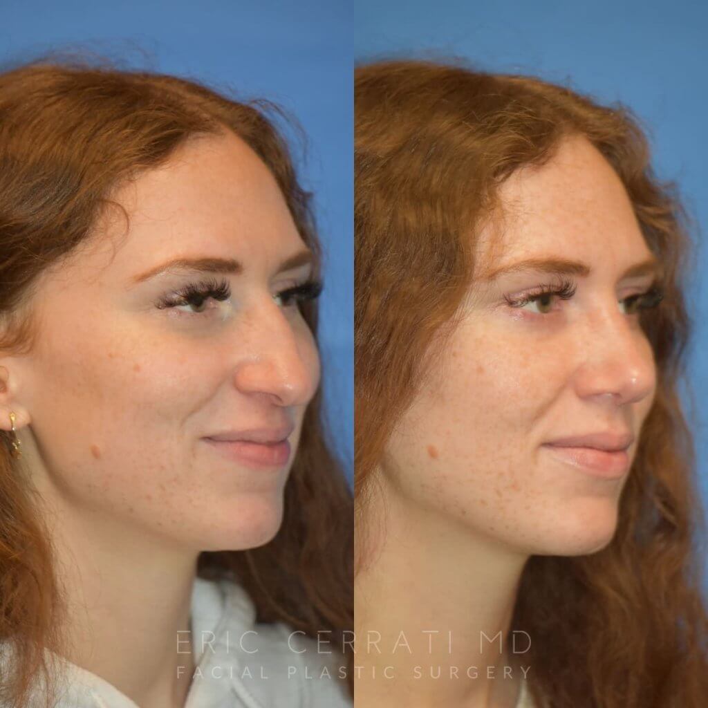 Female patient before and after rhinoplasty - right side