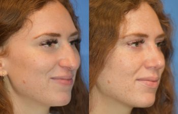 Female patient before and after rhinoplasty - right side