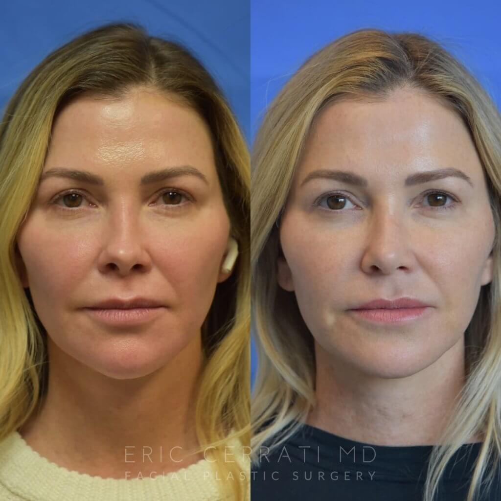 Female patient before and after rhinoplasty - front