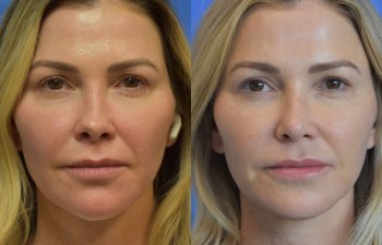 Female patient before and after rhinoplasty - front