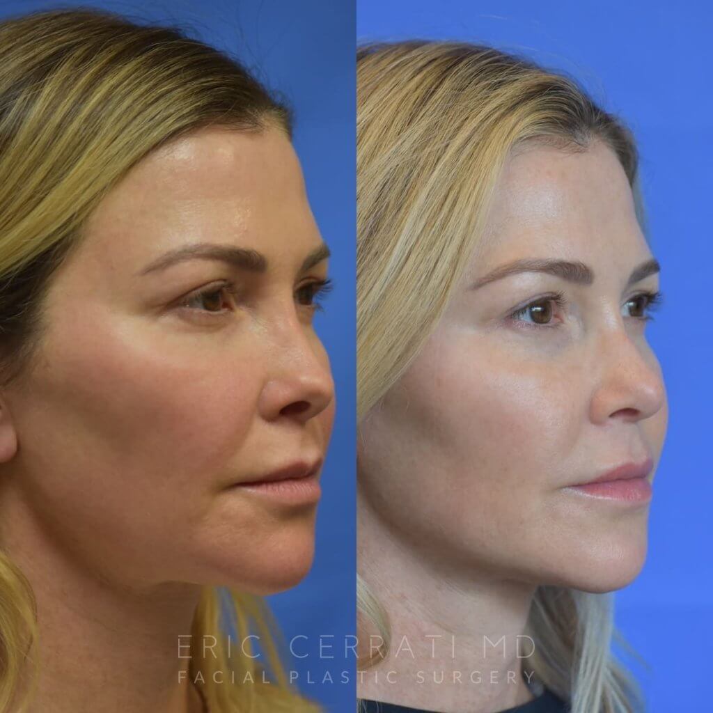 Female patient before and after rhinoplasty - right side