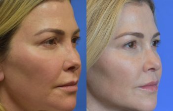 Female patient before and after rhinoplasty - right side