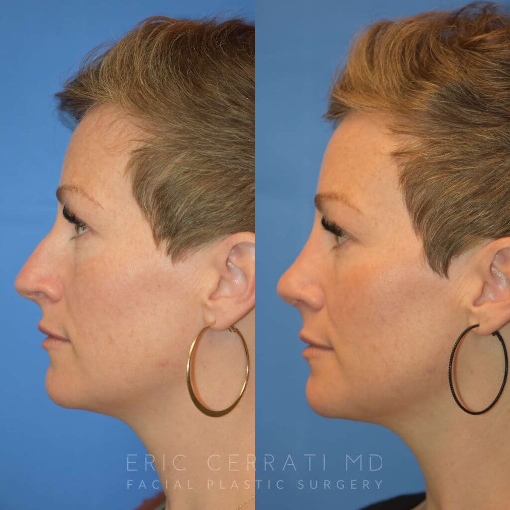 Female patient before and after rhinoplasty - left side