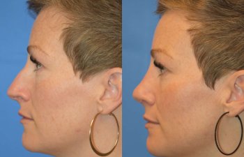 Female patient before and after rhinoplasty - left side