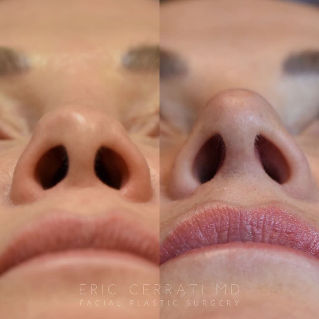 Female patient before and after rhinoplasty - base
