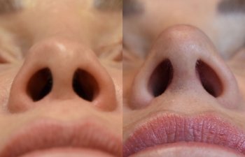 Female patient before and after rhinoplasty - base