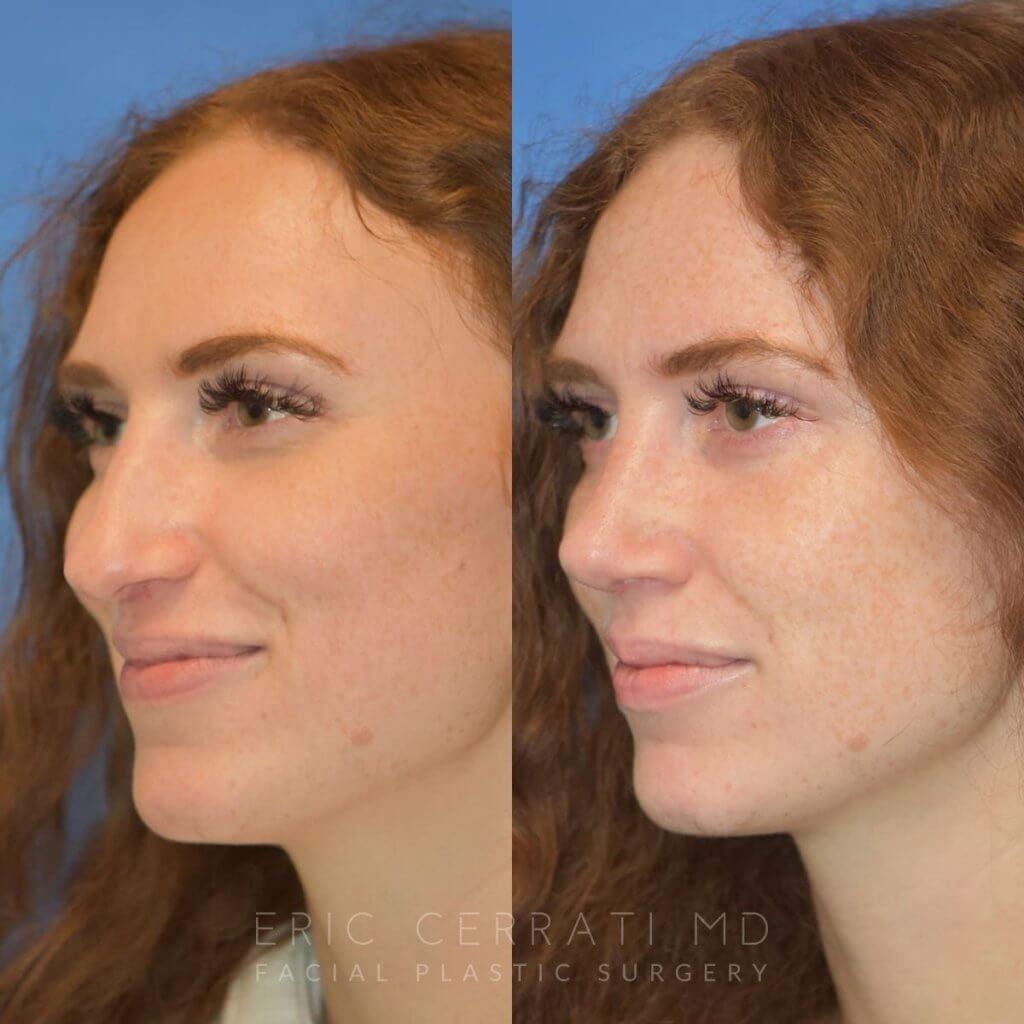 Female patient before and after rhinoplasty - left side