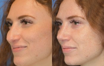 Female patient before and after rhinoplasty - left side