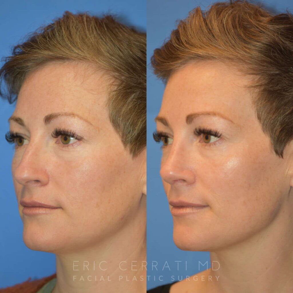Female patient before and after rhinoplasty - left side