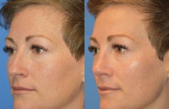 Female patient before and after rhinoplasty - left side