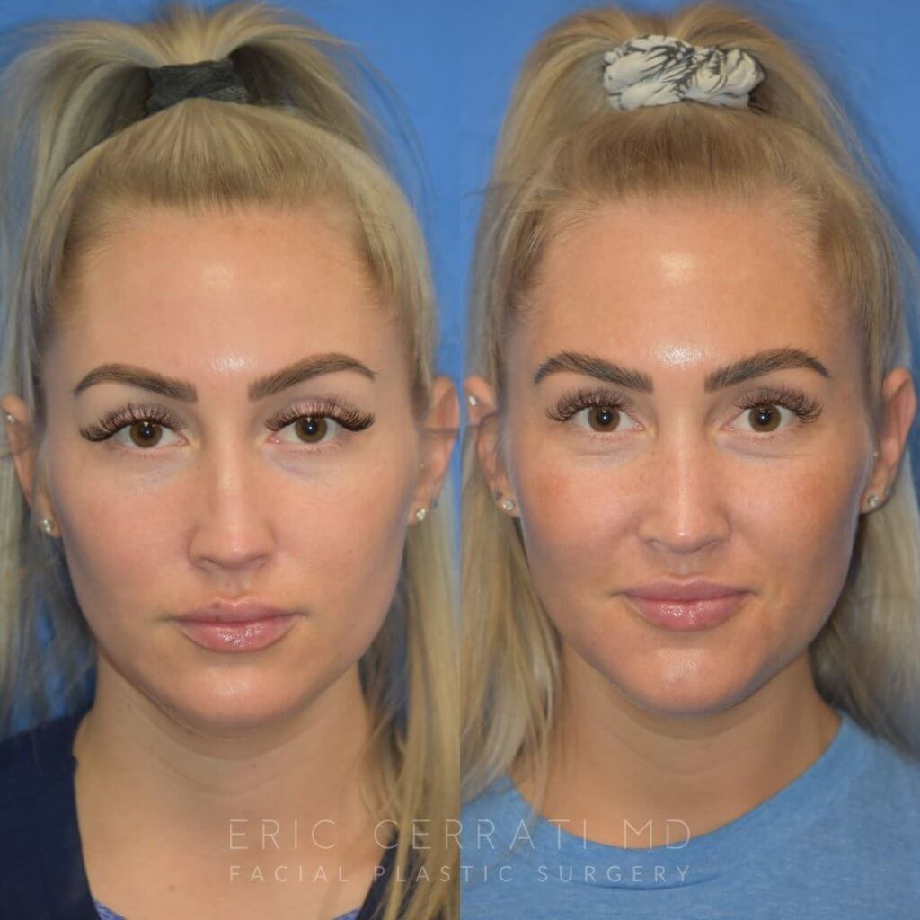 Female patient before and after rhinoplasty - front