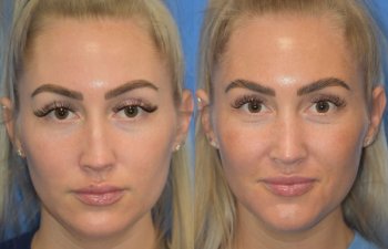 Female patient before and after rhinoplasty - front