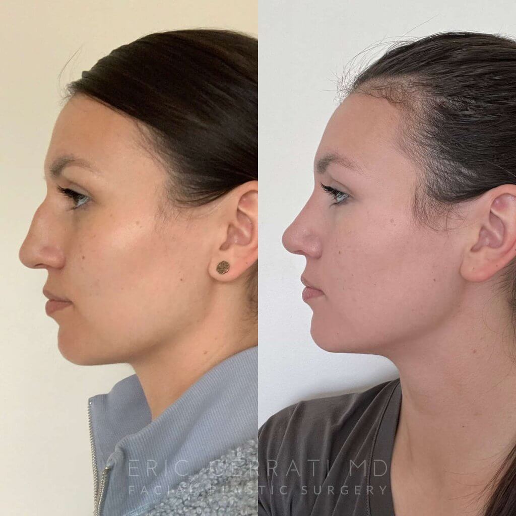 Female patient before and after rhinoplasty - left side